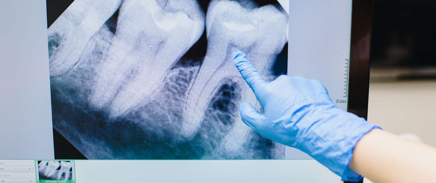 pexels screen with tooth xray Northwest Dental